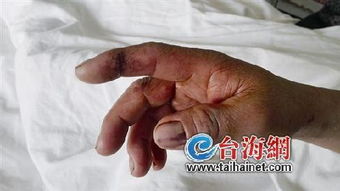 男生因女友咬傷手部疼痛難忍，緊急送醫(yī)