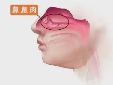 女子頭痛之謎，鼻子竟發(fā)霉的驚人真相