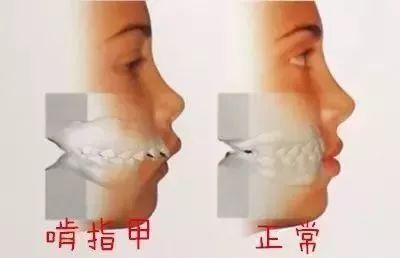 反復(fù)啃咬指甲，一種心理障礙的探索
